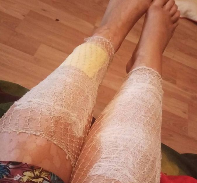 Leczenie ran po depilacji zajmie Anastasii nawet pół roku