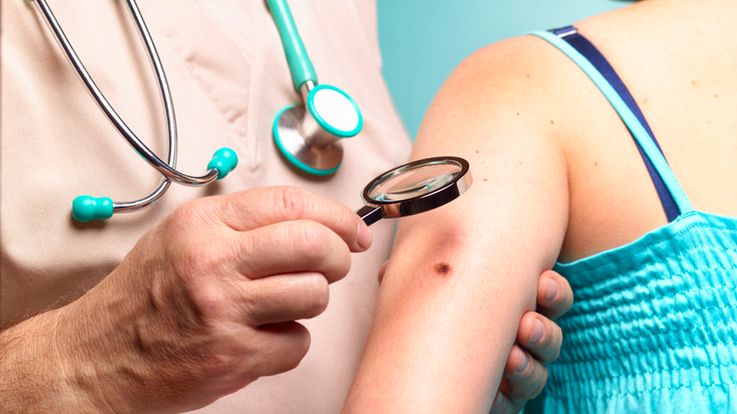 Choroba Bowena to postać raka przedinwazyjnego skóry.