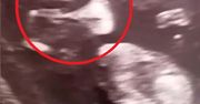 Widzieli to już na USG. Nawet lekarze byli zaskoczeni