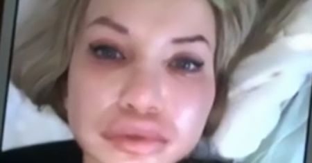Powiększyła usta w domu. Efekt jest przerażający (WIDEO)