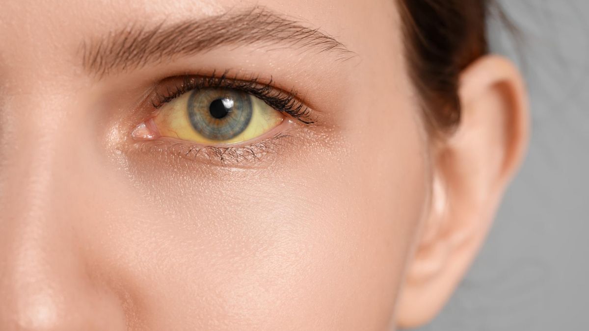 Zespół Rotora może odpowiadać za zażółcenie skóry oraz oczu.