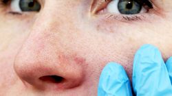 Choroba Morgellonów - przyczyny, objawy i leczenie