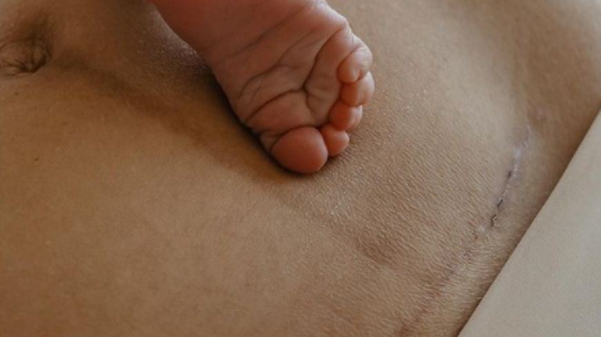 Klaudia Helejcio pokazała bliznę po cesarskim cięciu