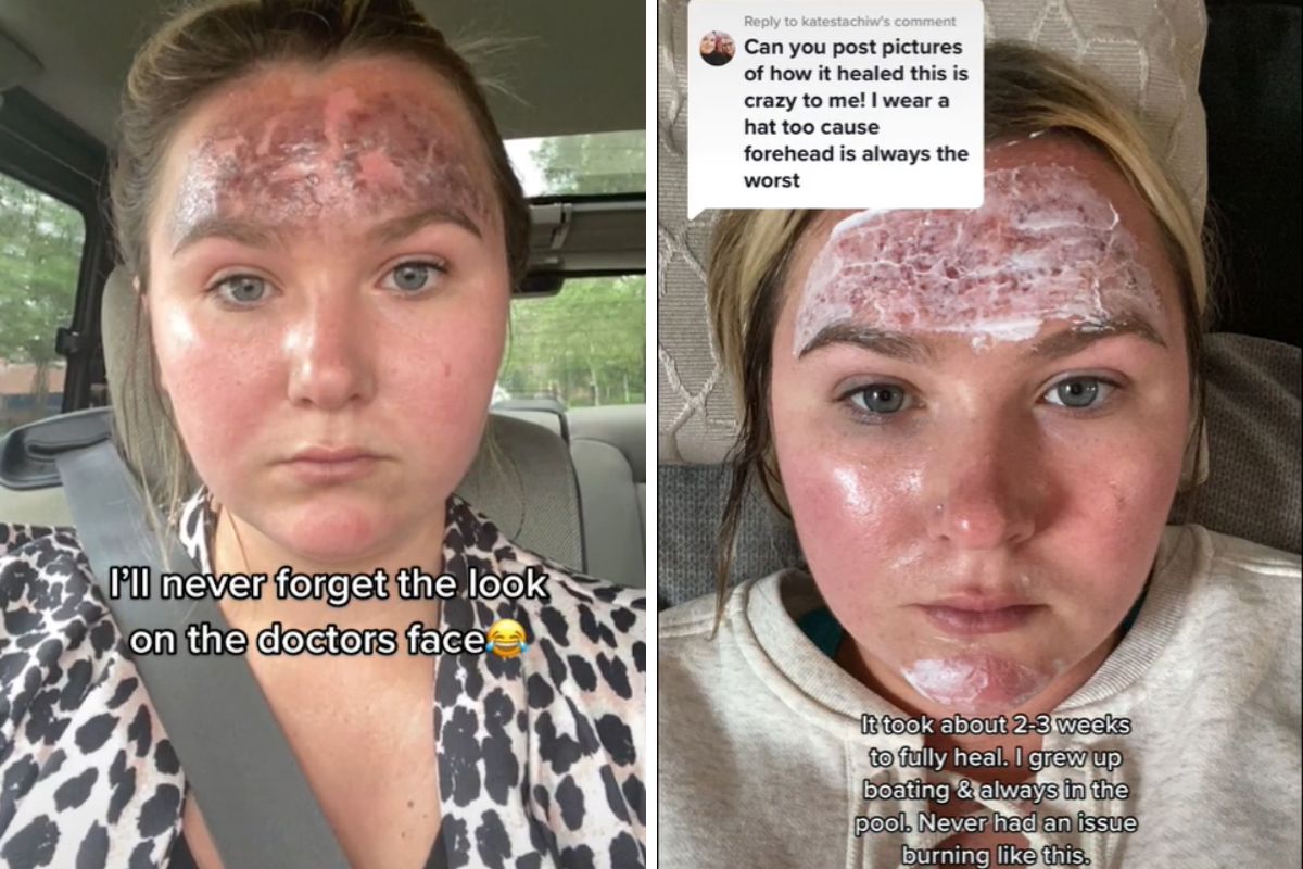 Skóra na czole dziewczyny była mocno poparzona