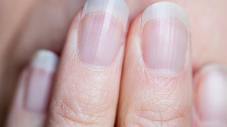 Objaw pojawia się na paznokciach. Znak, że nerki mogą być w fatalnym stanie
