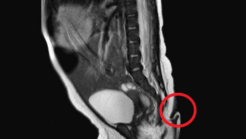 Dziewczynka urodziła się z kilkucentymetrowym ogonem.