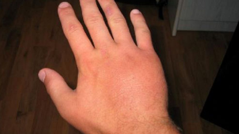 Spuchnięte dłonie to nie tylko defekt kosmetyczny czy przypadłość, która wywołuje dyskomfort. Można to również traktować jako sygnał, że w organizmie dzieje się coś niepokojącego.