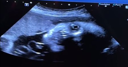 Niezwykłe nagranie z USG. "Twarz demona"