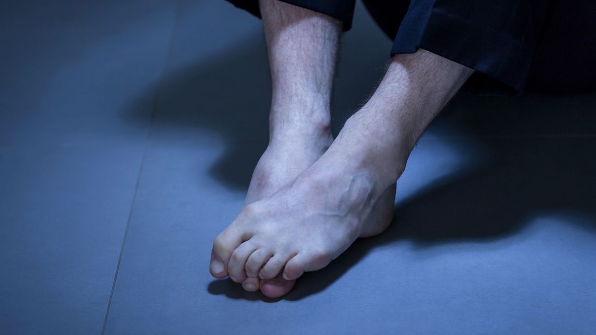 NAFLD podąża za epidemią otyłości na świecie