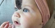 Urodziła się z czarnym znamieniem na twarzy. Lekarze nie chcieli go usunąć
