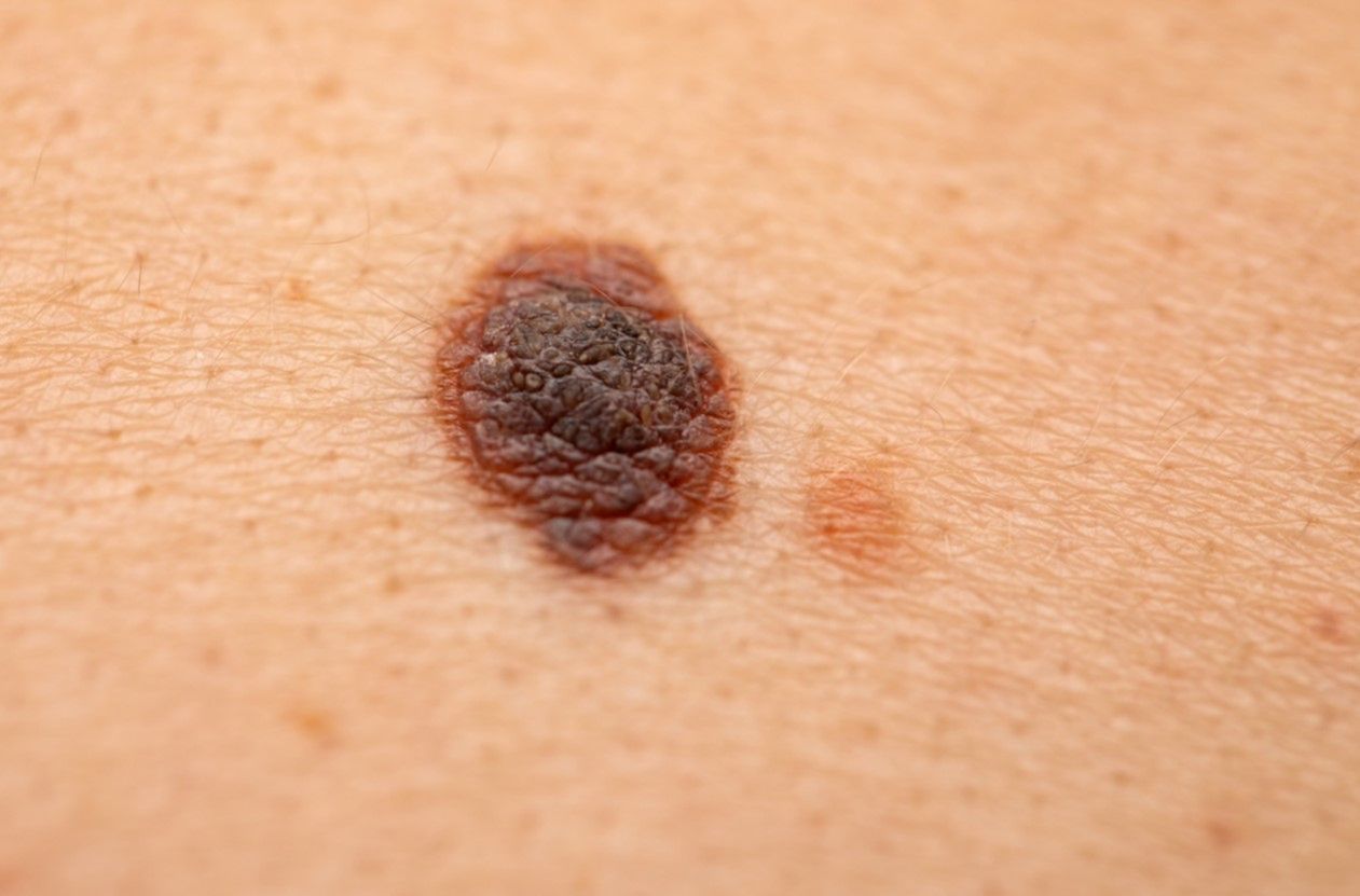 Usuwanie pieprzyków za pomocą tradycyjnych i innowacyjnych metod. Chirurgia, krioterapia, laseroterapia, elektrokoagulacja