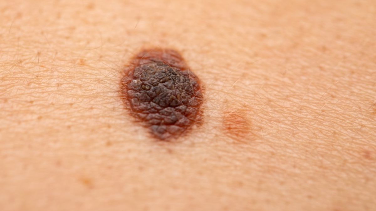 Pieprzyki można usuwać za pomocą chirurgii, laseroterapii bądź krioterapii.