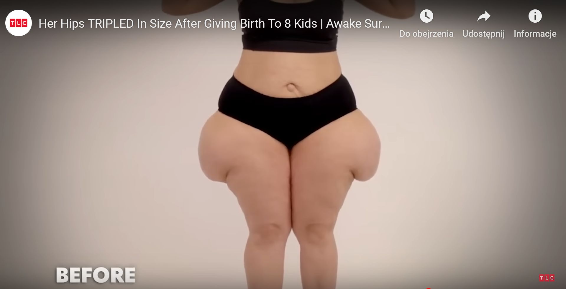 Tak wyglądały uda Rubi przed operacją