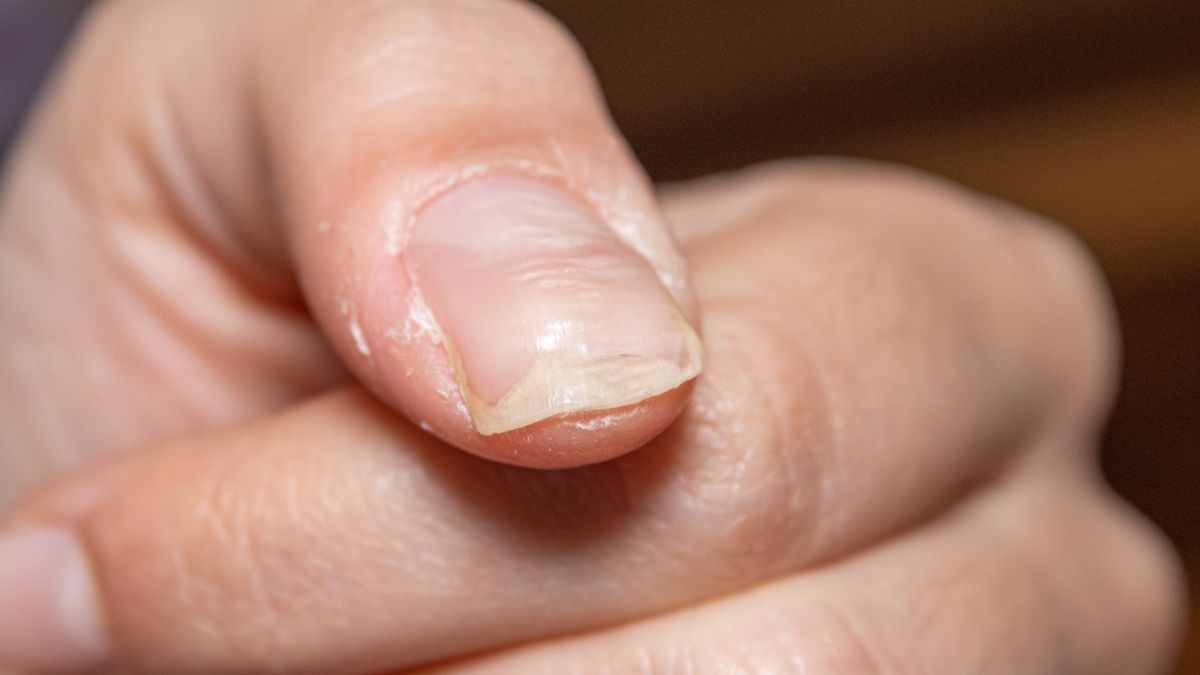 Bruzdy na paznokciach stanowią niewielki defekt kosmetyczny