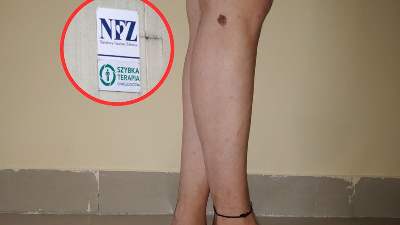 Coraz więcej diagnoz czerniaka. NFZ apeluje o profilaktykę