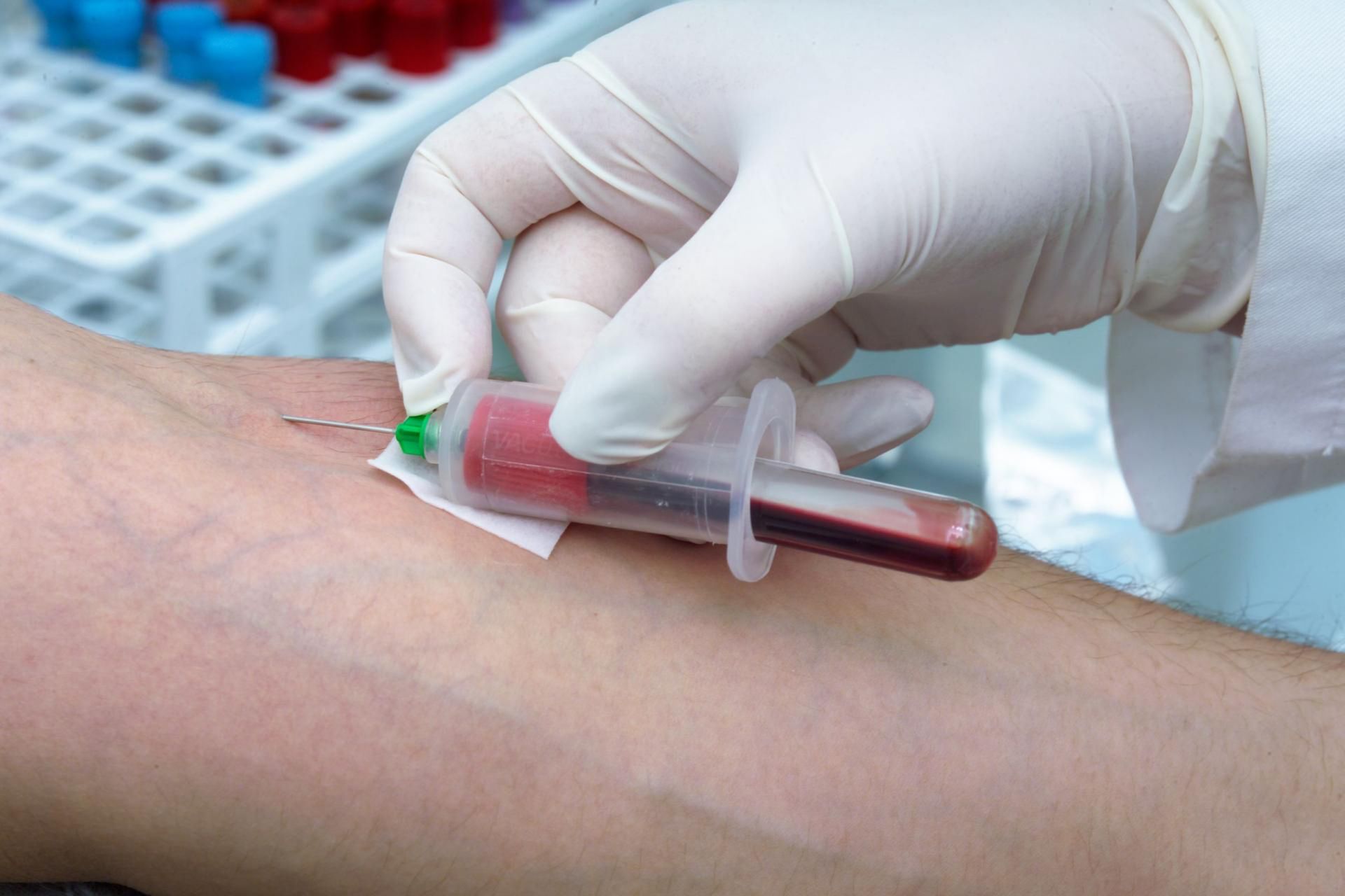 Cukrzycę najczęściej rozpoznaje się przypadkowo w czasie przeprowadzania rutynowych badań kontrolnych krwi