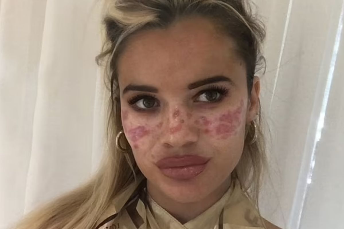 Wytatuowała sobie piegi. "Blizny pozostaną ze mną do końca życia"