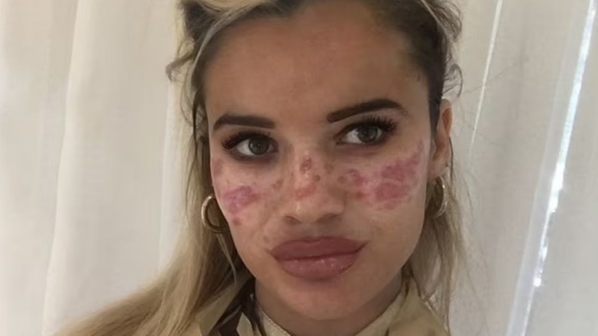 Samodzielnie wytatuowała sobie piegi: tusz kupiła w internecie. "Blizny pozostaną ze mną do końca życia"