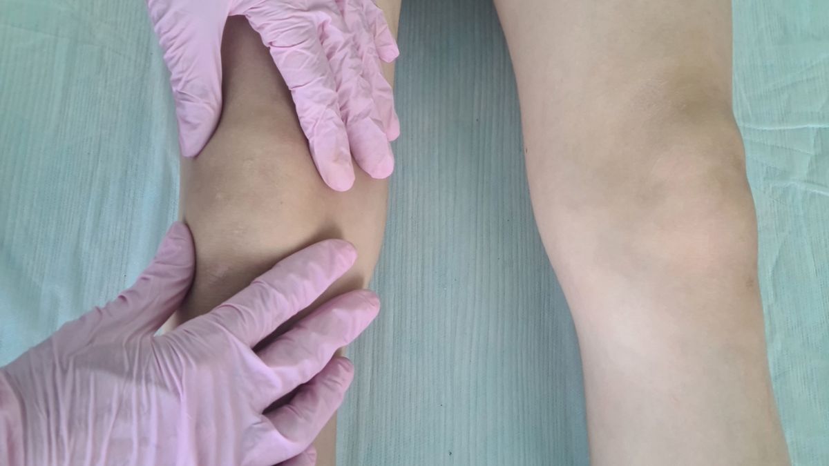 Kolana szpotawe można niwelować poprzez ćwiczenia pomagające wzmocnić mięśnie nóg