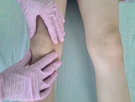 Kolana szpotawe – przyczyny, objawy i leczenie