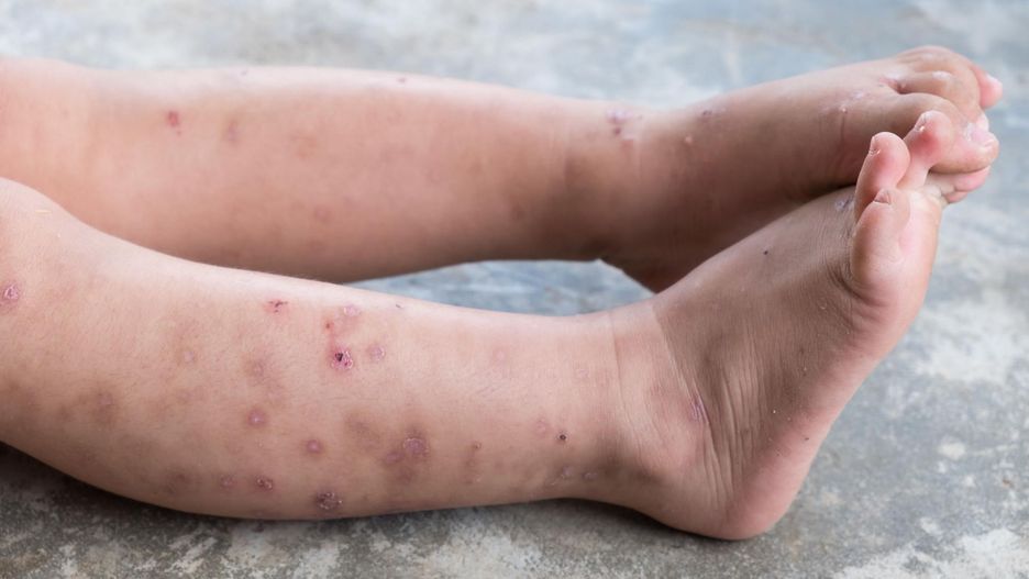 Atopowe zapalenie skóry – o jakiej porze roku się nasila?