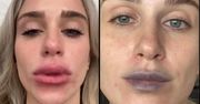 Chciała upiększyć usta. "Po wypełnieniu są spuchnięte, niebieskie i grudkowate"