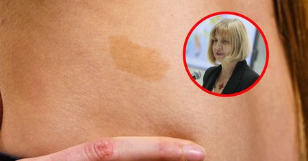Charakteryzuje się występowaniem guzów. Objawy neurofibromatozy często widać na skórze