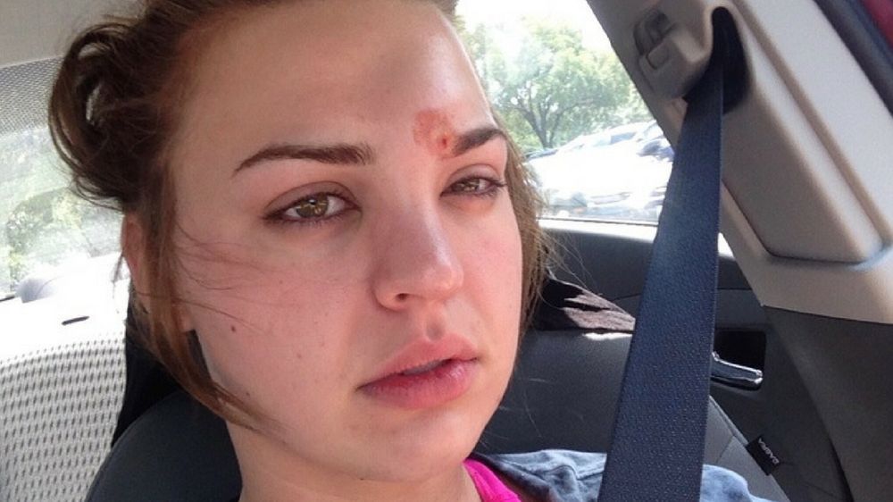 Katie myślała, że na jej twarzy pojawił się pryszcz. Był to cellulitis