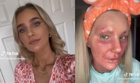 Produkt dosłownie wyżarł jej skórę. 26-latka ostrzega innych