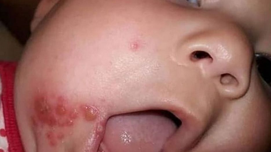 Zauważyła dziwne bąble na twarzy niemowlęcia. Okazało się, że to opryszczka