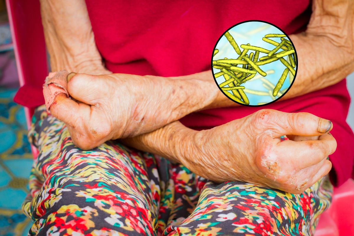 Pierwszy od ponad 40 lat przypadek trądu w Rumunii. Cztery kobiety pod nadzorem epidemiologicznym