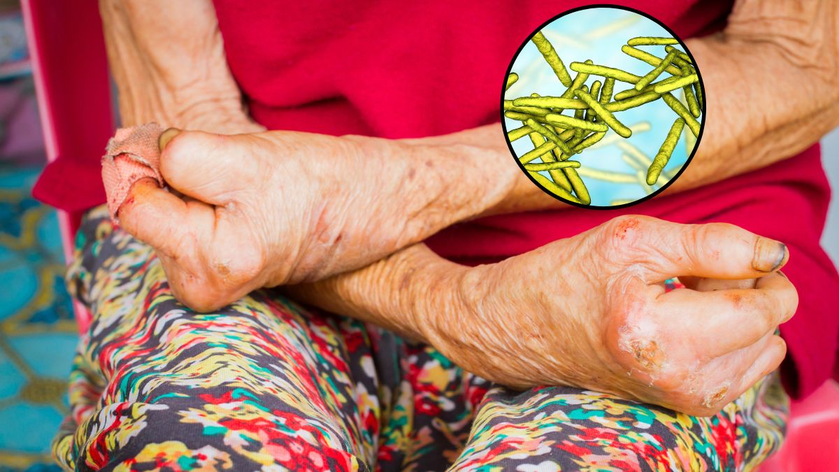 Nieleczony trąd powoduje szereg powikłań, w tym deformacje twarzy i kończyn