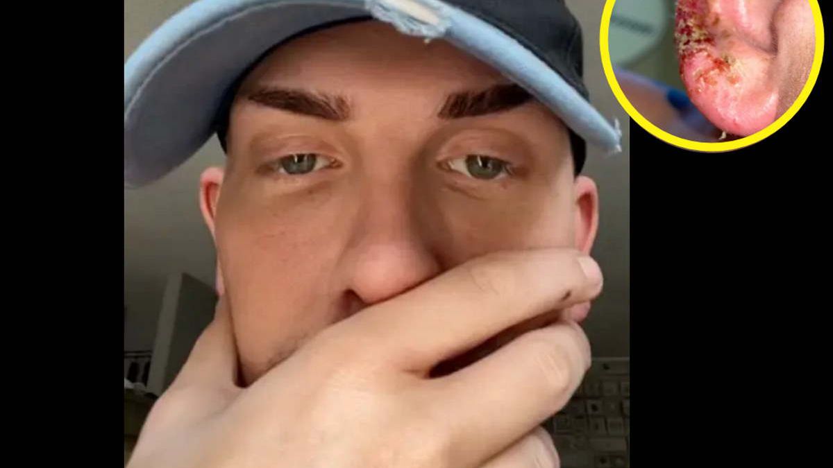 U 31-latka zdiagnozowano oparzenia i zatrucie słoneczne