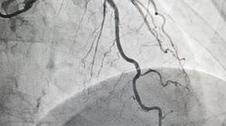 4 ciche znaki, świadczące o tym, że możesz mieć zatkane tętnice