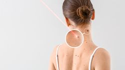 Brodawka łojotokowa - co to jest i jak wygląda, przyczyny, usuwanie