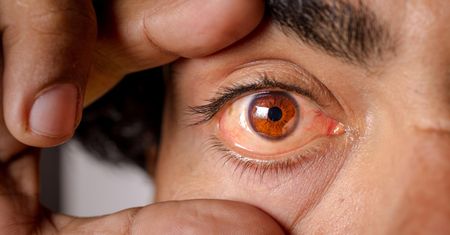 Masz problemy ze wzrokiem? To może być objaw wysokiego cholesterolu