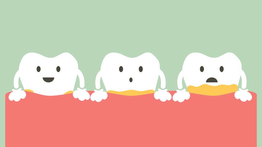 Kamień nazębny to twardy osad, który powstaje ze zwapniałej płytki nazębnej