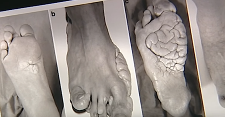 Zespół Proteusza – przyczyny, objawy, diagnostyka i leczenie