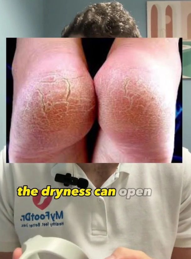 Przesuszenie stóp i pękniecia są szczególnie groźne dla diabetyków