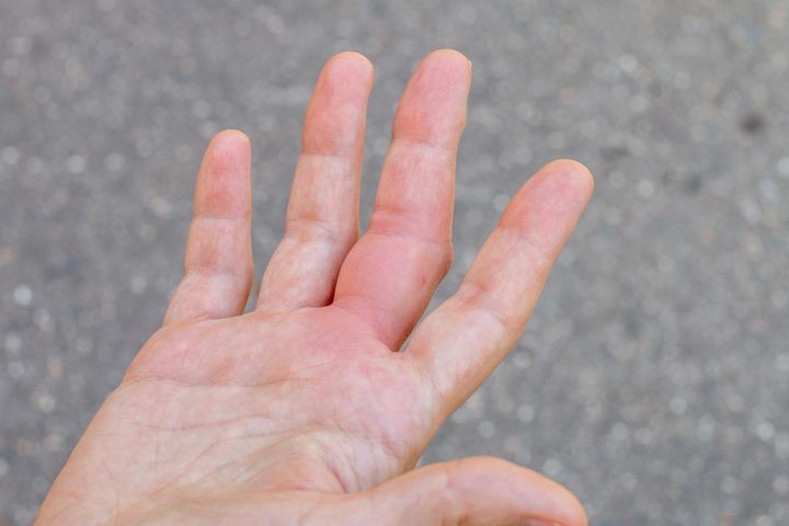 Kolor dłoni może być wskazówką dotyczącą niektórych schorzeń