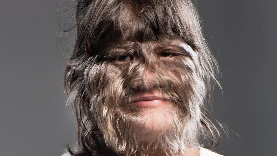 Dziewczynka z "syndromem wilkołaka"