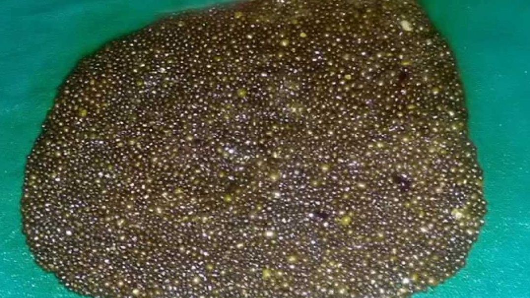 W ciele Hinduski znaleziono 12000 kamieni żółciowych