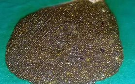 W ciele Hinduski znaleziono 12000 kamieni żółciowych