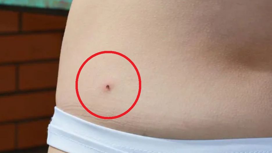 Nimfy kleszcza. Łatwo pomylić je z pieprzykiem