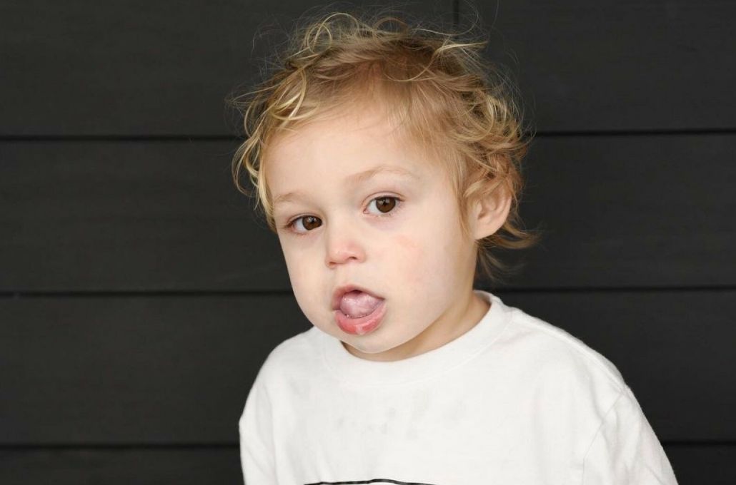 Chłopiec urodził się z rzadką chorobą. Jego język wciąż rośnie