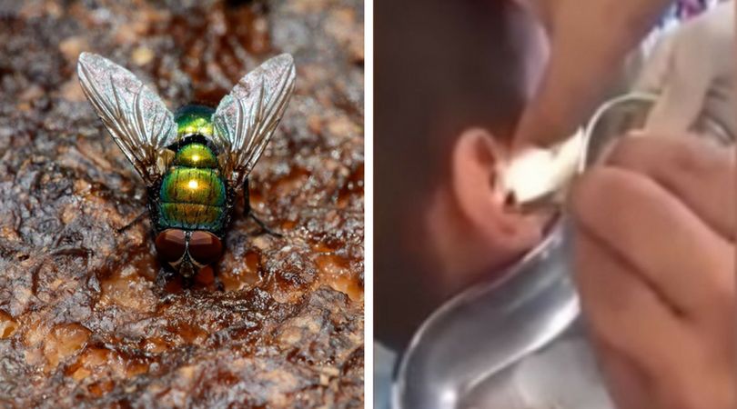 Chłopiec skarżył się na uporczywy ból głowy. Lekarz usunął z jego ucha larwy muchówek [WIDEO]