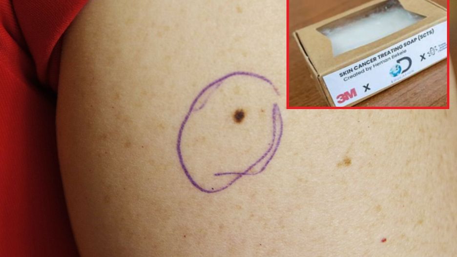 14-latek wynalazł mydło, które leczy raka skóry. Nazwano go "najwybitniejszym młodym naukowcem Ameryki"