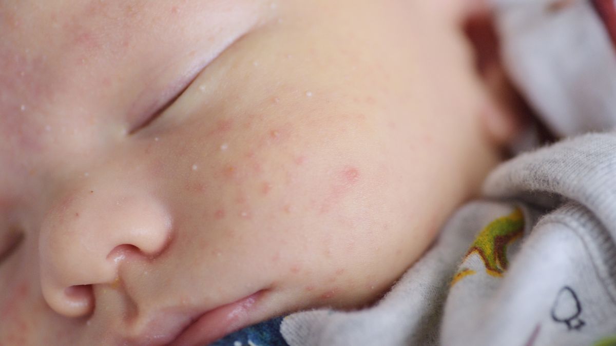 Rumień noworodkowy pojawia się na skórze w ciągu 48 godzin po narodzinach.