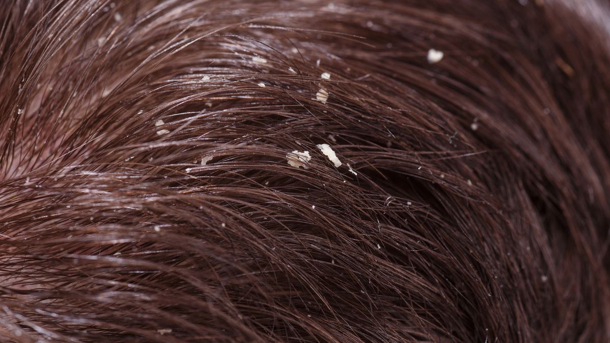 Łupież łojotokowy (łupież tłusty) to dermatologiczna choroba skóry z tendencją do nawrotów.