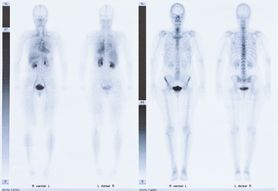 Scyntygrafia kości - wskazania, badanie w chorobach nowotworowych, przebieg